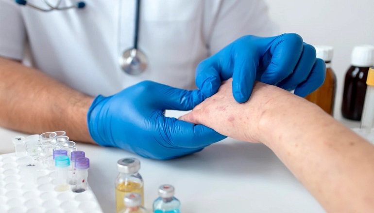 Nota: Prefeitura orienta teixeirenses para a prevenção e o combate da nova varíola